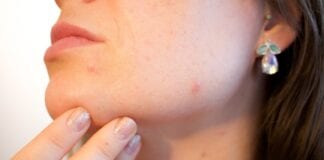 7 Best Herbal Treatments For Acne Prone Skin 2021